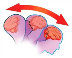 признаки сотрясения головного мозга